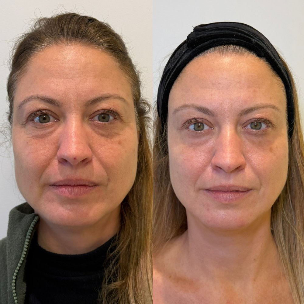 Antes e depois: Frente: ganho de sustentação no terço médio e suavização do sulco, preservando a expressão.