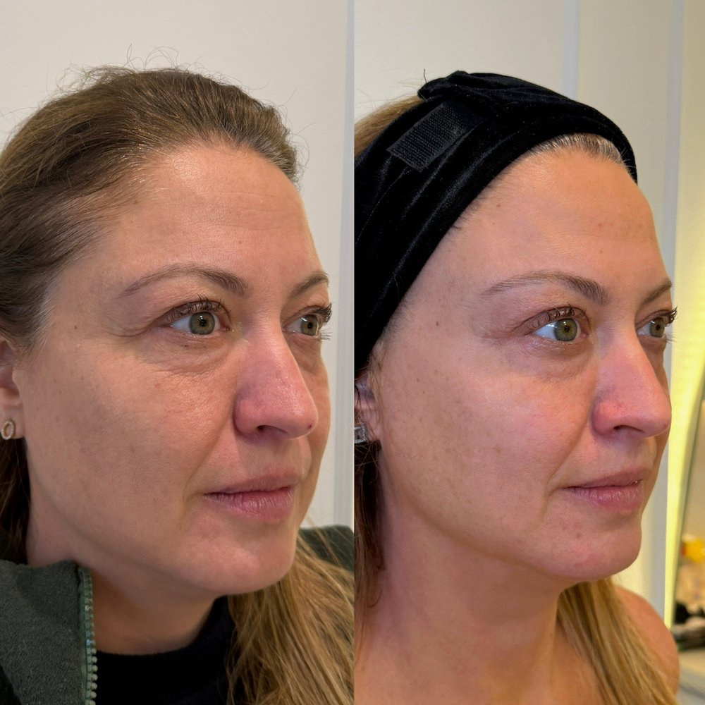 Antes e depois: Perfil: definição do contorno e do terço inferior, com o traço do rosto preservado.