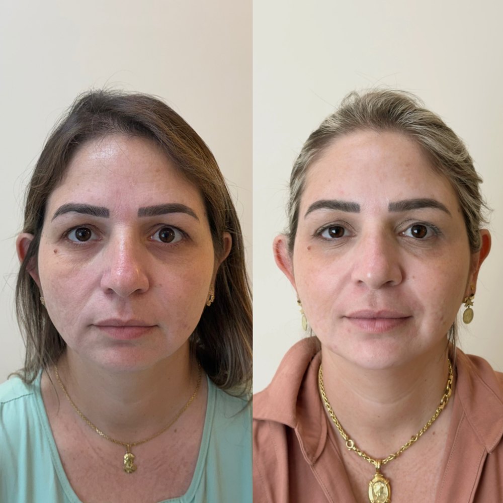 Antes e depois: Frente, antes e depois do protocolo.