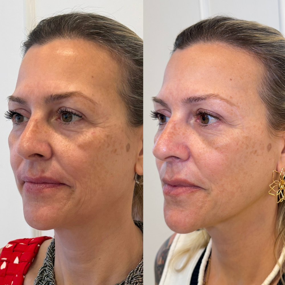 Antes e depois: Três quartos, antes e depois do protocolo.