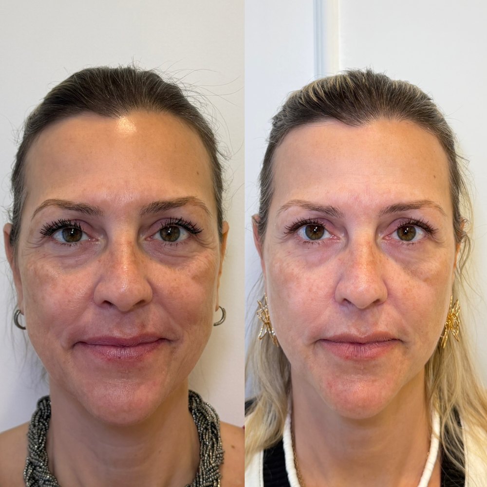 Antes e depois: Frente, antes e depois do protocolo.